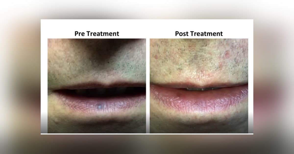 Vascular Surgeon Brings Specialized Expertise to Venous Lake Treatment